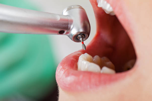 Best Knocked-Out Tooth (Avulsed Tooth) Treatment in Honea Path, SC